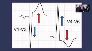 Left Ventricular Hypertrophy [upl. by Nnaes]