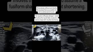 Fibromatosis colli radiology [upl. by Akimik]