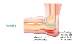 Treating Bursitis [upl. by Eilram]