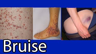 Bruise Hematoma blue spots on skin causes and treatment [upl. by Araiek]