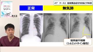 SpO2低下編7 ケース1 低酸素血症を引き起こす疾患 [upl. by Koran]