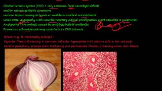 92P Morphology of Systemic lupus erythematosus SLE part 3 [upl. by Hephzipah284]