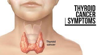 THYROID CANCER SYMPTOMS [upl. by Aifoz858]