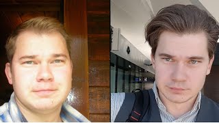 Truth About Finasteride My 12 Year Update Results [upl. by Kosey]