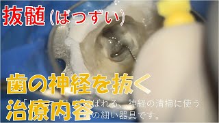 歯の神経を抜く治療抜髄処置pulpectomy、root canal [upl. by Mont]