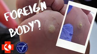 INFECTED FOOT  ABSCESS with GREEN PUS [upl. by Vani]