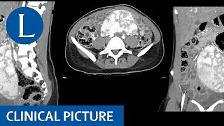 A wandering spleen splenomegaly hypersplenism and iron deficiency anaemia [upl. by Allehcim]