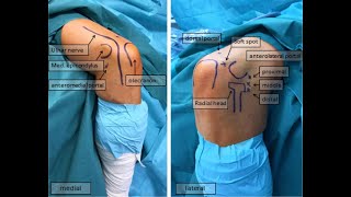 Arthroscopic ECRB tenotomy [upl. by Ariayek]