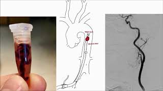 Thrombectomy in acute stroke – can we extend the time window [upl. by Klehm3]