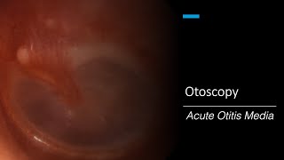 Acute Otitis Media Otoscopy [upl. by Schnell520]