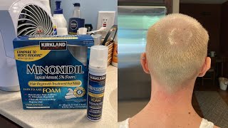 KIRKLAND SIGNATURE MINOXIDIL 5 FOAM 7 MONTH REVIEW AND HOW TO USE DEMO FOR HAIR REGROWTH TREATMENT [upl. by Jerold]