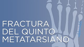 Fractura del quinto metatarsiano  IQTRA [upl. by Hidie892]