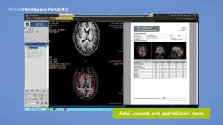 Philips IntelliSpace Portal 90 clinical application MR NeuroQuant® [upl. by Doug]