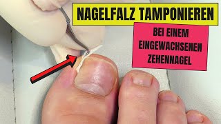 Nagel tamponieren bei EINGEWACHSENEN NÄGELN  Eingewachsene Nägel endlich loswerden [upl. by Todd]