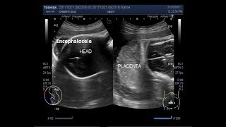 Ultrasound Video showing intrauterine fetal death with positive spalding sign and an encephalocele [upl. by Anderegg]