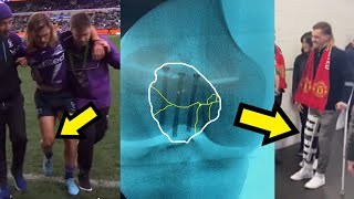 Ryan Papenhuyzens KNEE SURGERY for Patella Fracture Explained [upl. by Tray755]