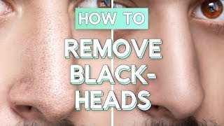 No Bullsht Blackhead Removal  How To Remove Blackheads From Face  Nose ✖ James Welsh [upl. by Dede]