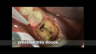 PHILIPS LASER Eviction gingivale technique 2wmv [upl. by Trow220]