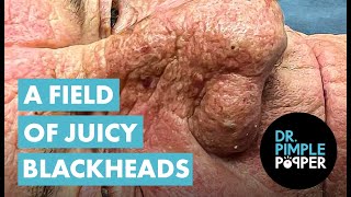 A FIELD OF JUICY BLACKHEADS [upl. by Siesser247]