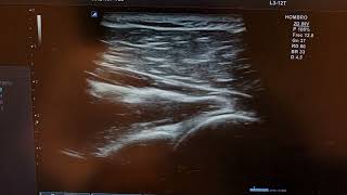 glenohumeral ultrasound injection shoulder ultrasound guided injection [upl. by Ramraj]