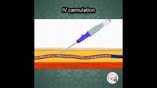 💉 INTRAVENOUS IV CANNULATION ANIMATION [upl. by Enyalb420]