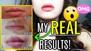 How To Get Plump Lips PERMANENTLY  BEFORE AND AFTER [upl. by Eentirb594]