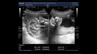 Anencephaly and Cystic Hygroma with a Pregnancy of about 21 weeks [upl. by Ellered]