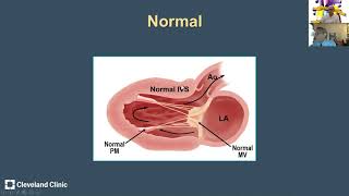 Hypertrophic Cardiomyopathy Anatomic Variants and Echocardiographic Pearls from Dr Harry Lever [upl. by Fionnula]