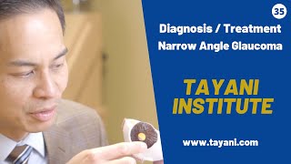 Narrow Angle Glaucoma  What To Expect  Tayani Institute [upl. by Nayve]