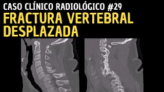 Caso Clínico 29 Fractura vertebral desplazada [upl. by Yvan120]