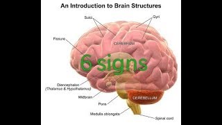 6 signs or symptoms of cerebral edema [upl. by Gnoht646]