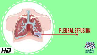 Pleural Effusion Causes Signs and Symptoms Diagnosis and Treatment [upl. by Holloway]