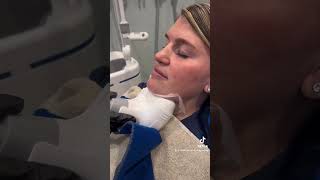 CoolSculpting Treatment on the chin [upl. by Sandra]