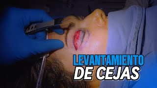 LEVANTAMIENTO de cejas CIRUGIA [upl. by Sheya]