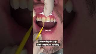 Fixing a chipped front tooth  composite bonding  Cosmetic Dentist Dr Yazdan [upl. by Aerdua]