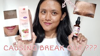 I tried rosehip oil for 3 weeks on my acne prone skin ⎮ English ⎮ Vlog 40 [upl. by Breen]