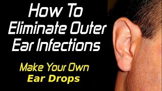 How To Treat Outer Ear Infections [upl. by Nywnorb]