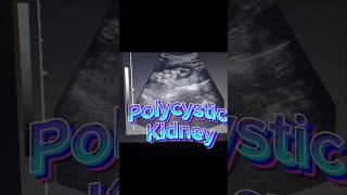 Polycystic Kidneys  Renal Cysts  Kidney Cysts on ultrasound [upl. by Enelyar113]