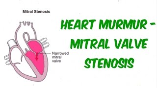 Mitral Stenosis  Auscultation Sound [upl. by Rhine]