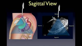 Transvaginal Pelvic Ultrasound Lecture [upl. by Novyad30]