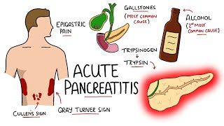 How is chronic pancreatitis diagnosed [upl. by Carolee]