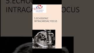 Echogenic intracardiac focus on antenatal scanwhat does it mean echogenicfocus heart [upl. by Immaj642]