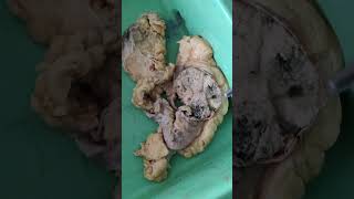 seminoma testis  lung abscess  lipoma  breast adenocarcinoma  renal cell carcinoma pathology [upl. by Gilchrist]