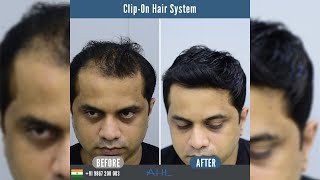 Clip on Hair Systems in India  Hair PatchesWigs for men [upl. by Smallman]