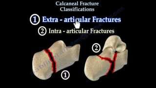 Calcaneal Fracture Classifications  Everything You Need To Know  Dr Nabil Ebraheim [upl. by Cordle]