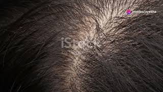 DHT Hormone The Hairfall Culprit Explained DHThairfallhaircareyoutubehair [upl. by Benedikt758]