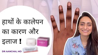 हाथों के कालेपन  कारण और ईलाज  Dark knuckles  त्वचा के डॉक्टर [upl. by Vashtia]