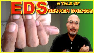 EhlersDanlos Syndrome EDS A Tale Of Broken Dreams [upl. by Aimac]