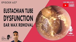 Eustachian Tube Dysfunction Treatment with Balloon Dilation [upl. by Aiynat]