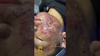 Feedback “GY” blackhead sacdepspa [upl. by Kramlich462]